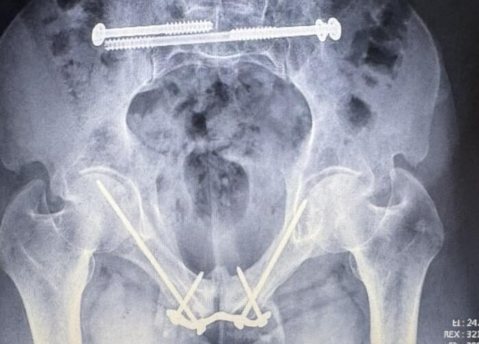 Radiografía de caso — Fractura de pelvis (anillo pélvico)