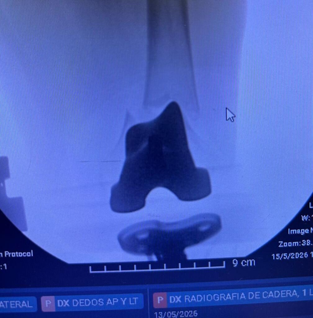 Radiografía de caso — Fracturas periprotésicas