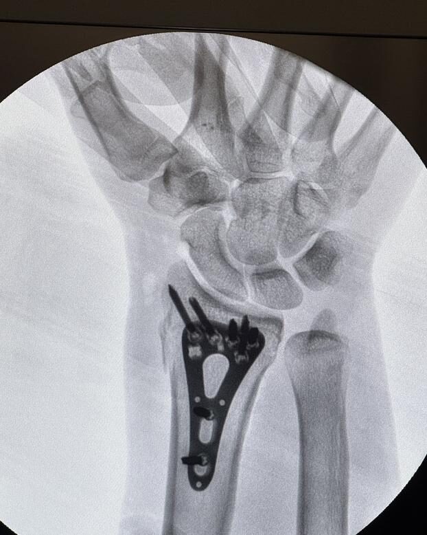 Radiografía de caso — Fractura de radio distal (muñeca)